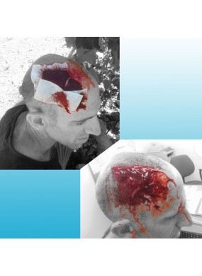 Platzwunde, gut versorgt mit WoundClot!